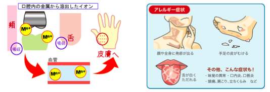 金属溶け出し